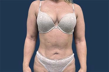 patient after renuvion treatment