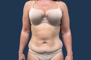 patient before renuvion treatment