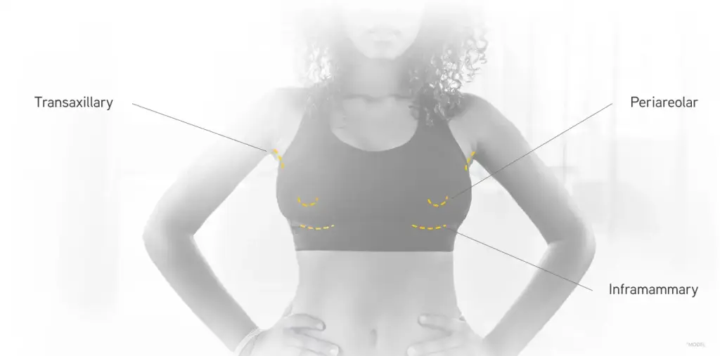 breast augmentation diagram